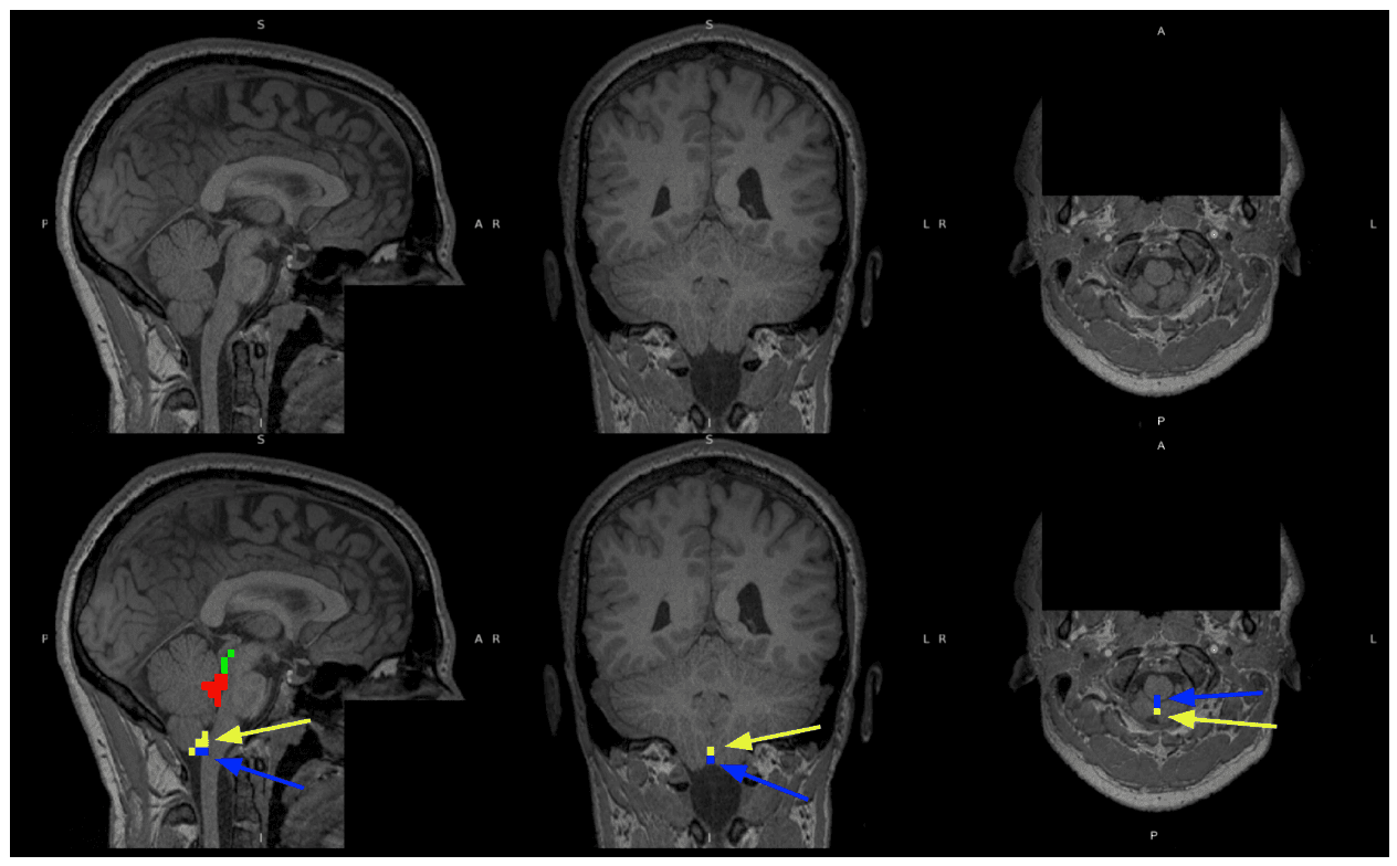 Modulating cerebrospinal fluid dynamics using pulsed photobiomodulation: feasibility, parameter and skin-colour dependence figure